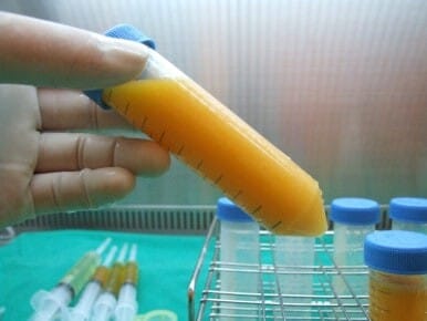 지방과 지방 줄기세포를 이용한 흉터(수술, 여드름, 사고, 화상, 방사선) 개선